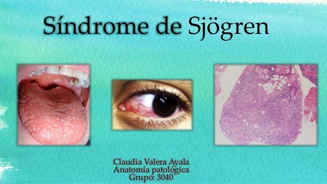 sindrome de sjogren
